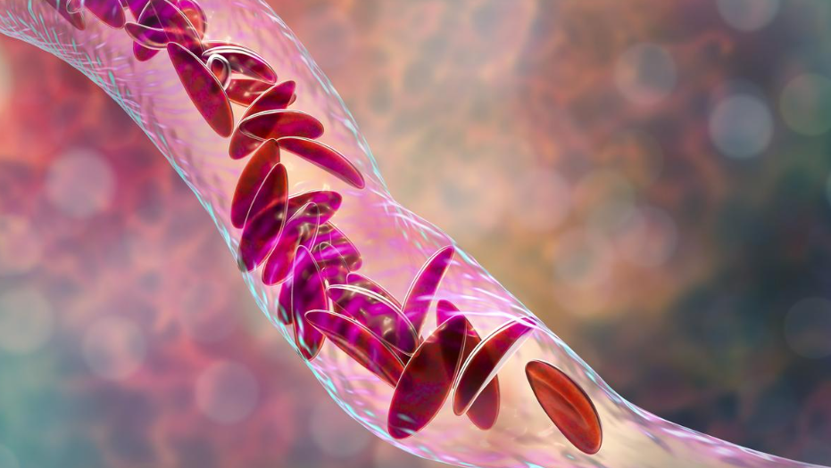 India&rsquo;s Sickle Cell Challenge (GS Paper 2, Health)
